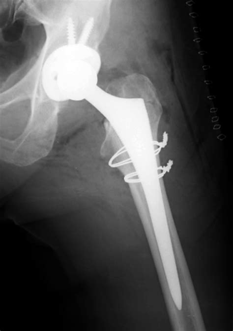 Joint Arthroplasty A Gallery