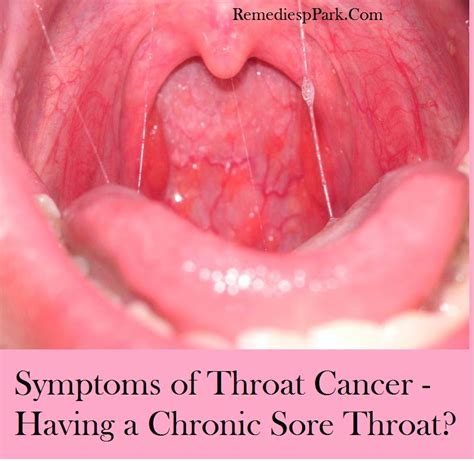 Pain or discomfort in your throat that doesn't go away is one of the most common symptoms of throat cancer. Cancer Types: Types Of Cancer In The Throat