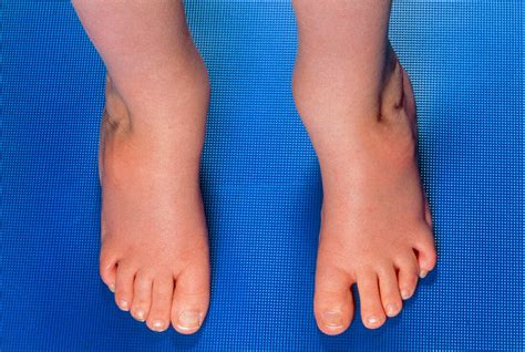 Club Foot Images Clubfoot In Newborns Causes Symptoms Diagnostics