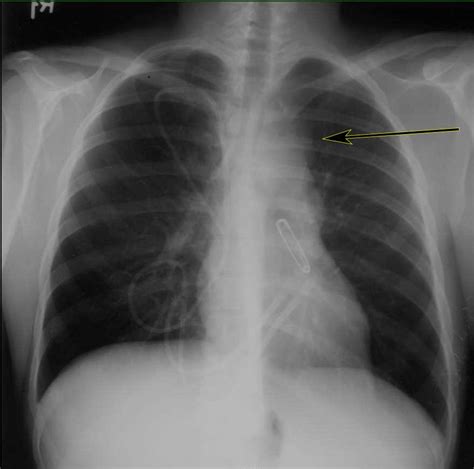 Lymphoma On Chest X Ray X Rays Case Studies Ctisus Ct Scanning