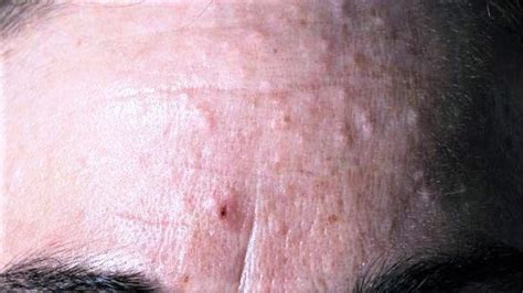 Laser Sebaceous Hyperplasia Removal Sydney And Canberra Queen Of The Skin