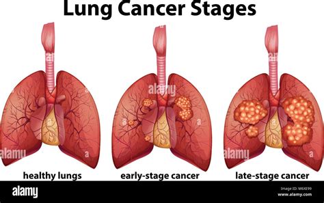 Diagram Showing Lung Cancer Stages Illustration Stock Vector Image