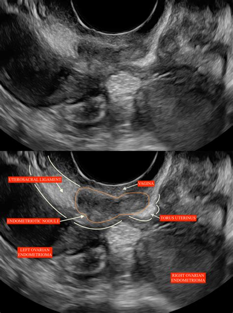 Jcm Free Full Text Ultrasound Of The Uterosacral Ligament Hot Sex Picture
