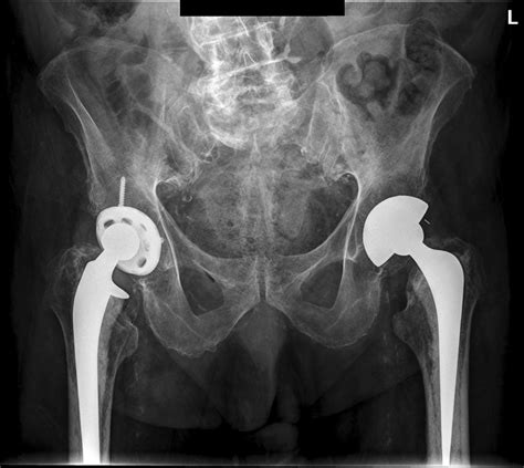 Imaging Periprosthetic Hip Fractures Wikiradiography