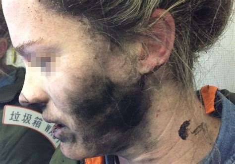 Woman Injured After Her Battery Operated Headphones Exploded Mid Flight