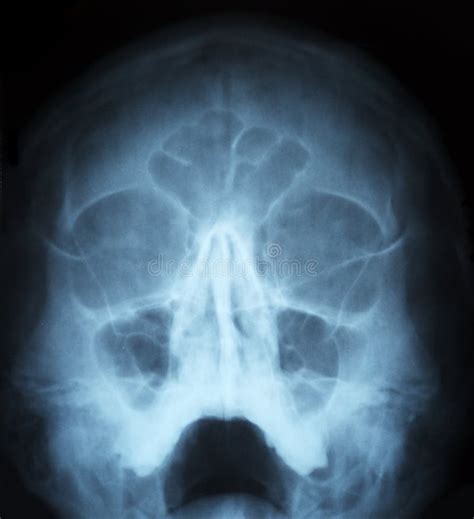 X Ray Of Human Skull Stock Image Image Of Anatomy Black 28295919