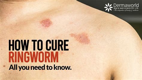 Type Of Ringworm How To Cure Ringworm All You Need To Know About