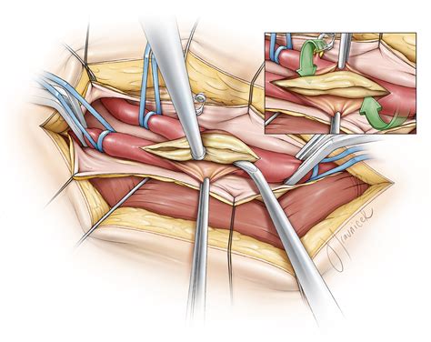 Carotid Endarterectomy The Neurosurgical Atlas