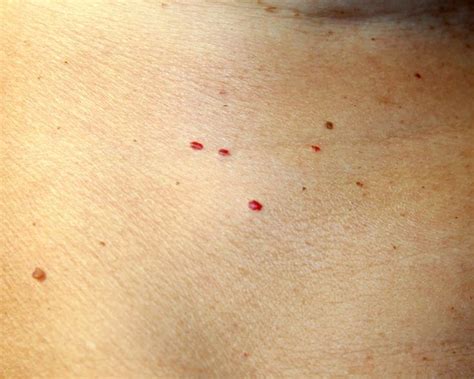 Why Red Spots Are Suddenly Showing Up On Your Skin Red Skin Spots