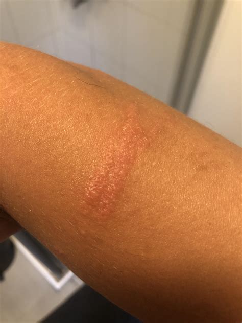 Raised Rash That Has Come About On My Forearm In The Last Few Days