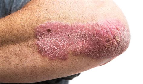 Psoriasis What Is The Dry Skin Condition Symptoms And