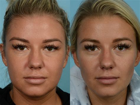 The Rise Of Buccal Fat Removal