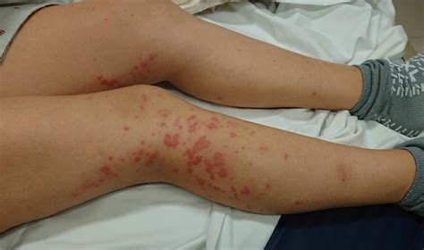 Case Study Lower Extremity Rash And Abdominal Pain Clinical Advisor