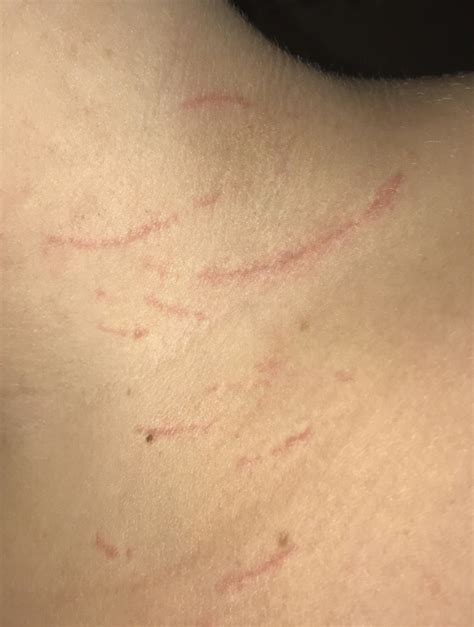 Scratch Marks On Skin Teach Besides Me