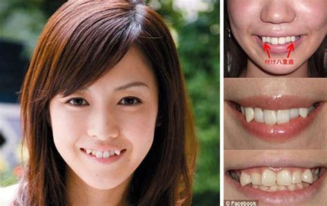 Beautiesmoothie Yaeba Crooked Teeth Trend Japan