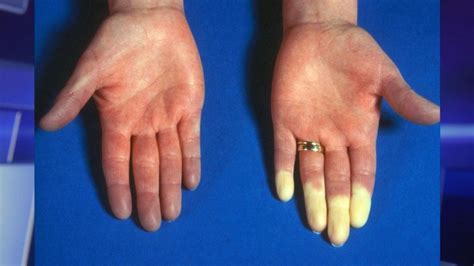 Raynauds Disease Symptoms Causes And Risk Factors