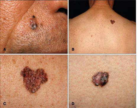 Figure From Basal Cell Nevus Syndrome Showing Several Histologic Types Of Basal Cell Carcinoma