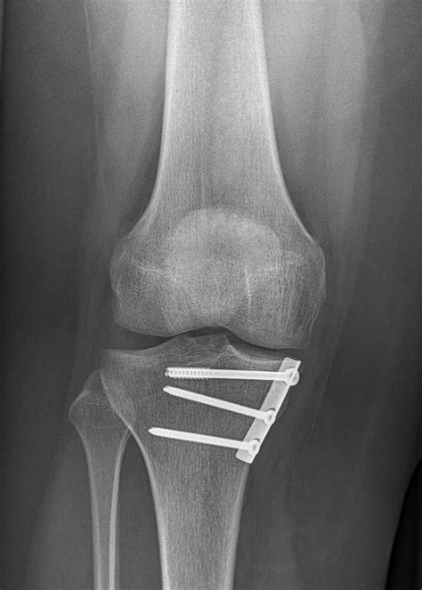 Knee Upside Down Bmj Case Reports