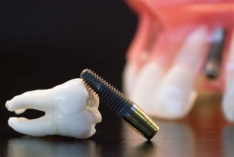 We did not find results for: Are Dental Implants Covered by Insurance in Canada? - Smile Well Dental