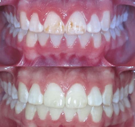 Brown Stains On Teeth After Braces Removed Teethwalls