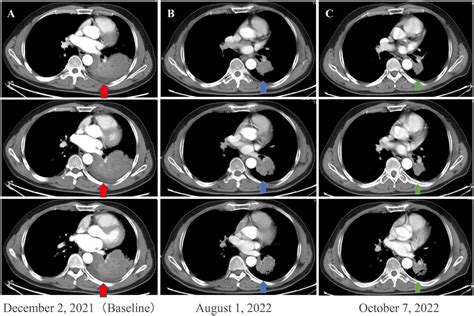 Enhanced Chest Ct Scans Of The Patient During Neoadjuvant Therapy A