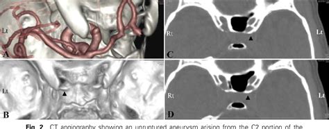 Figure 2 From Surgical Microanatomy Of The Anterior Clinoid Process For Paraclinoid Aneurysm