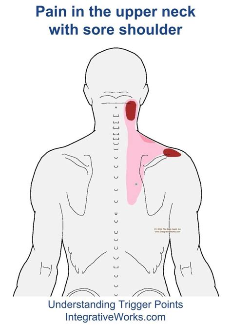 63 Best Shoulder Trigger Point Pain Images On Pinterest Low Back