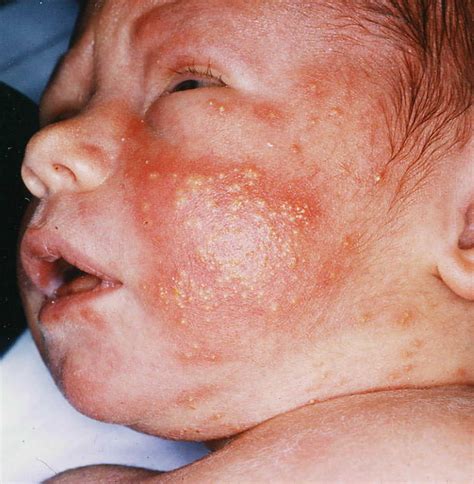 The younger the baby, the more vulnerable they are to the harmful effects of infection. Erythema toxicum neonatorum causes, diagnosis & erythema ...