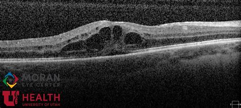 Moran Core Uveitis Complicated By Cystoid Macular Edema