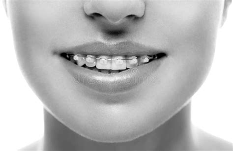 Portrait Young Black Woman Orthodontist Braces Stock Photos Free