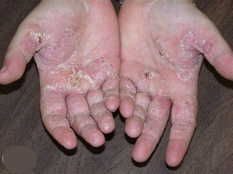 Eczema Hand Face Baby Causes Symptoms Treatment