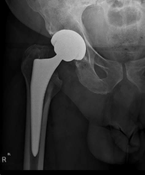 Hip Replacement Surgery 321gomd