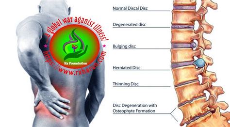 Lumbosacral Disc Herniation Causes Symptoms Treatment Rxharun