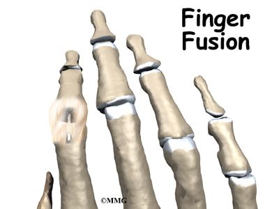 Mallet Finger Injuries | eOrthopod.com