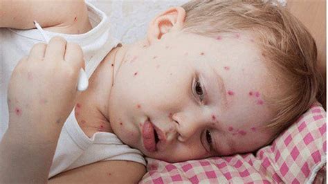 Baking Soda Is Best Home Remedy For Chickenpox Natural Home Remedy For