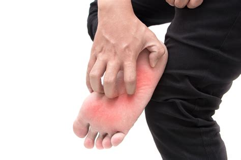 Burning Feet Syndroom Vaak Veroorzaakt Door Onderliggende Kwaal