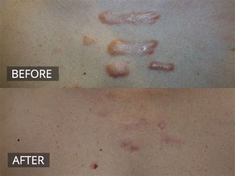 29 Keloid Scar On Chest Treatment Pictures