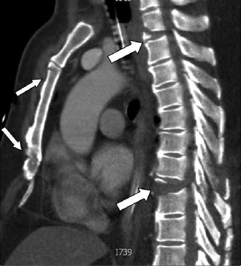 The Upper Thick Arrow Shows The Fracture Through Lower Endplate Of