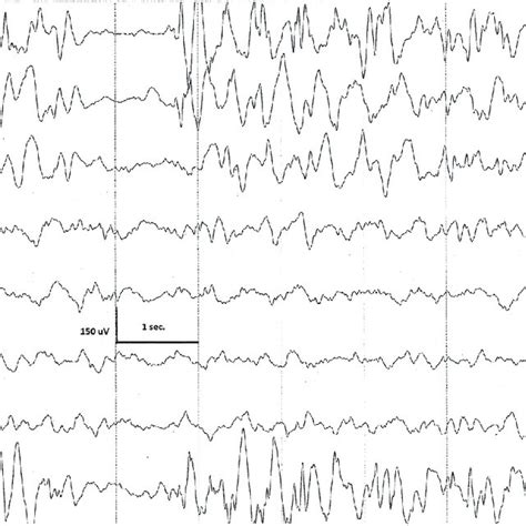The Interictal Eeg Recording Shows Pseudoperiodic High Amplitude Slow