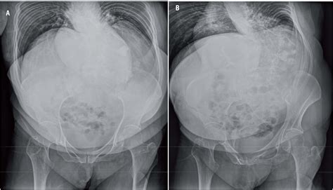 Scielo Brasil Minimally Invasive Percutaneous Nephrolithotomy