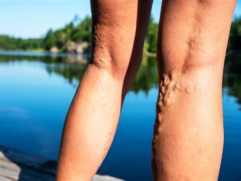 The 7 Most Common Myths About Varicose Veins Debunked Paramus Nj Patch