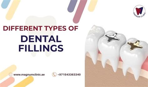 Different Types Of Dental Fillings Most Common Fillings