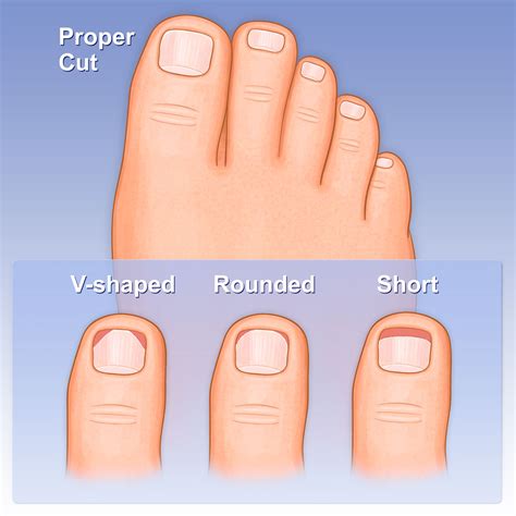 This is because the nails can become ingrown or embedded in the top corners of the toe, and ingrown nails can be really painful. Miscellaneous Medical Stock Art