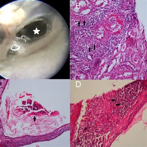 A Oto Endoscopic Image Of A Tympanic Membrane Perforation In Pars