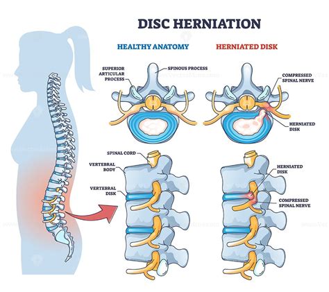 Cervical Fracture Human Spine Vertebrae Damage Outline Diagram Labeled