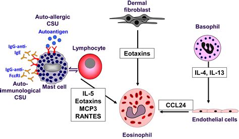 The Role Of Eosinophils In Chronic Spontaneous Urticaria Journal Of