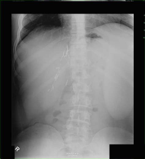 Splenomegaly On Abdominal X Ray X Rays Case Studies Ctisus Ct Scanning