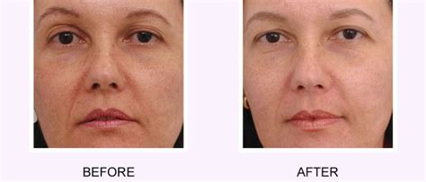 Softer Smoother And Healthier Skin With Photo Rejuvenation