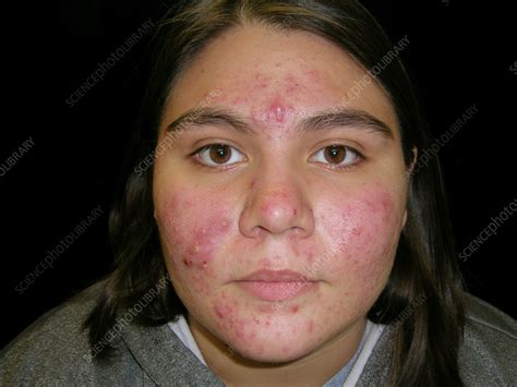 Cystic Acne Stock Image C0562502 Science Photo Library