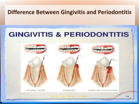 Ppt Difference Between Gingivitis And Periodontitis Powerpoint